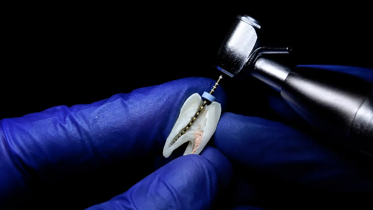 Tratamiento de conducto sobre un molar durante un procedimiento de endodoncia