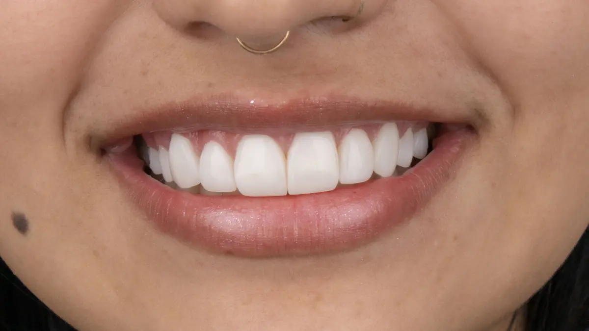 Close-up of a finished smile with a veneer smile design