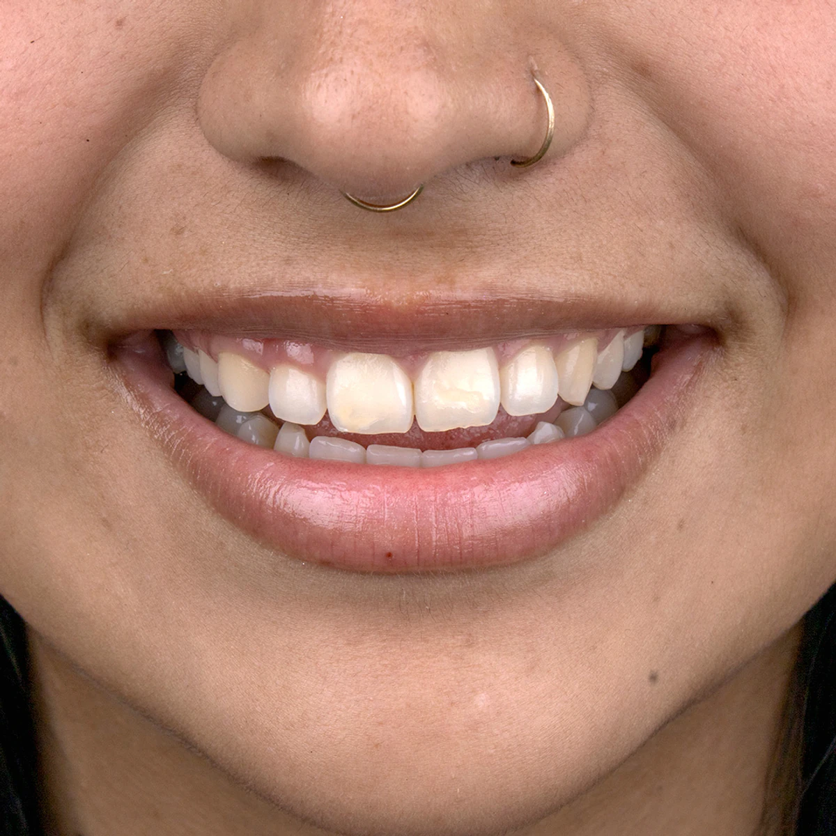Case 4, before