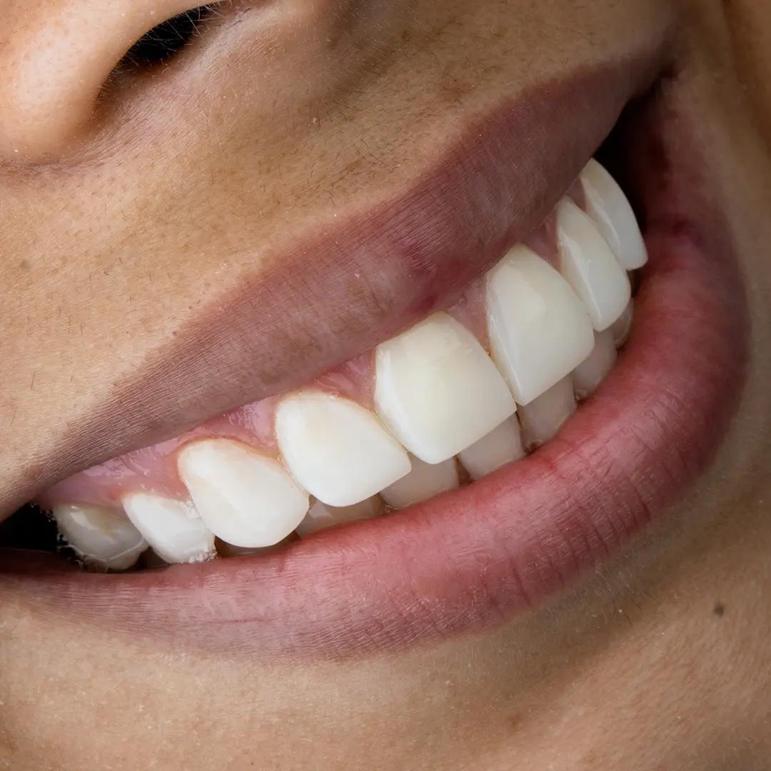Smile designed at Dras. Gelvez