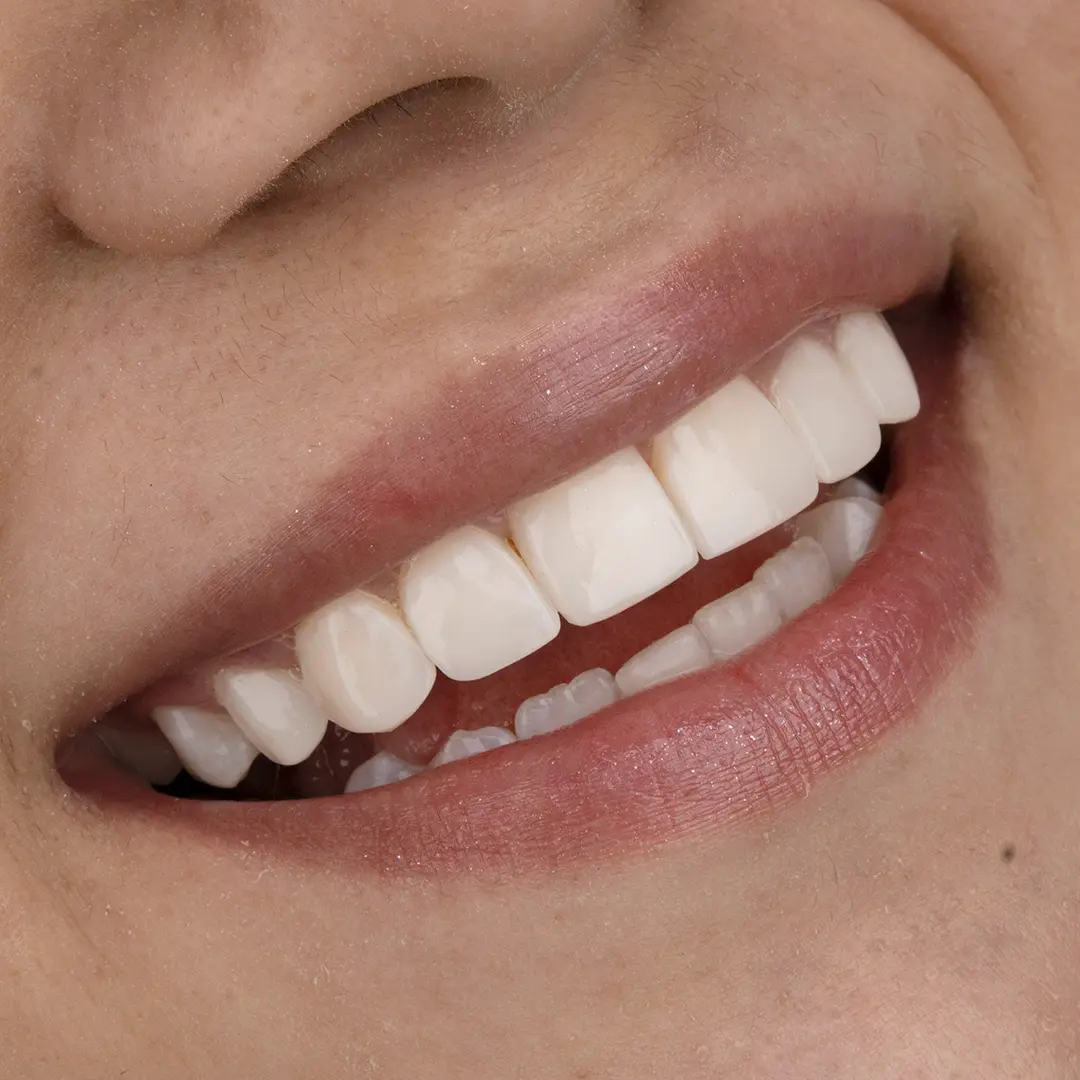 Smile designed at Dras. Gelvez