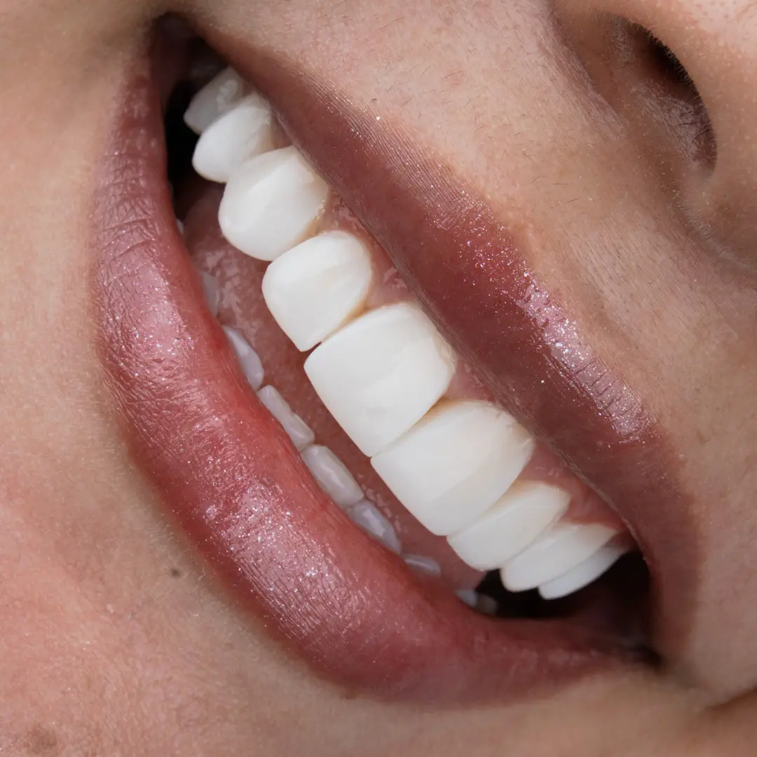 Smile designed at Dras. Gelvez