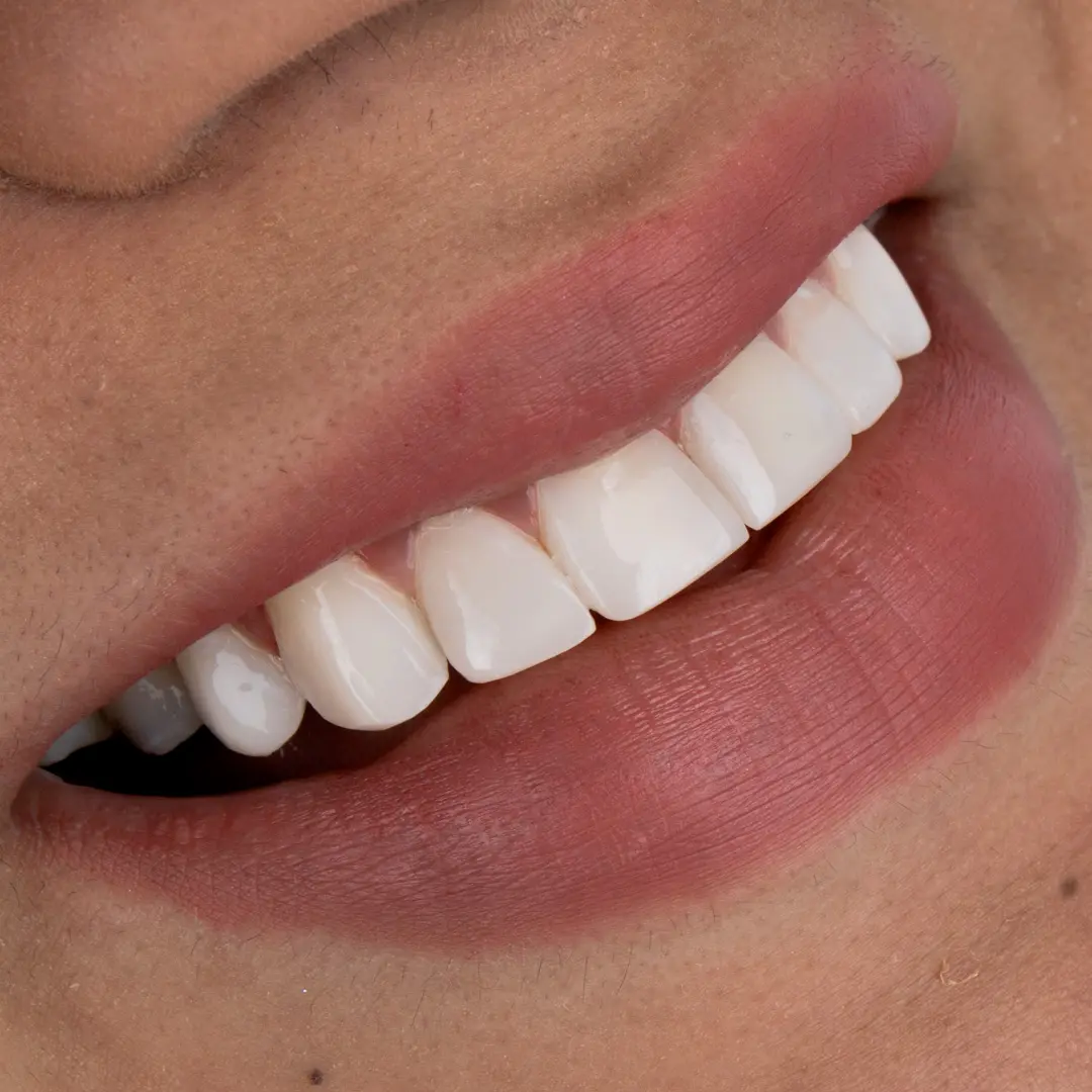 Smile designed at Dras. Gelvez