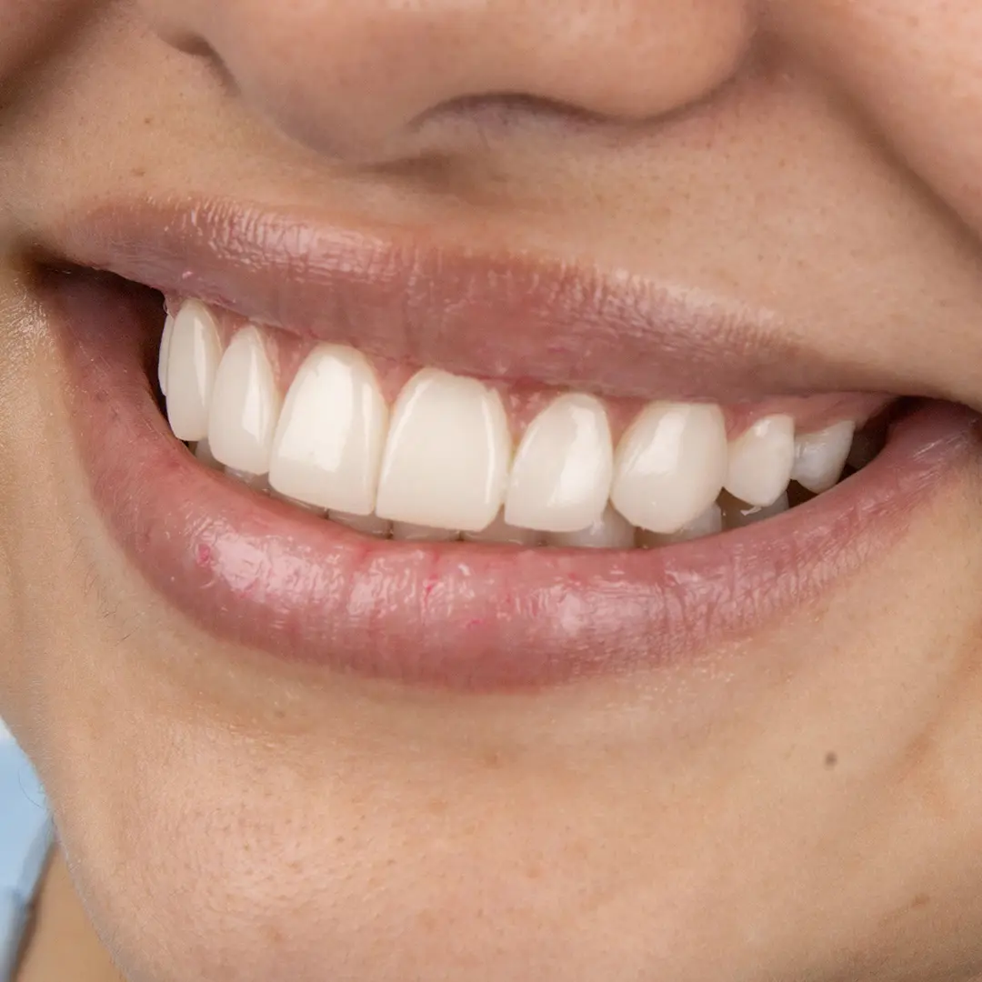 Smile designed at Dras. Gelvez