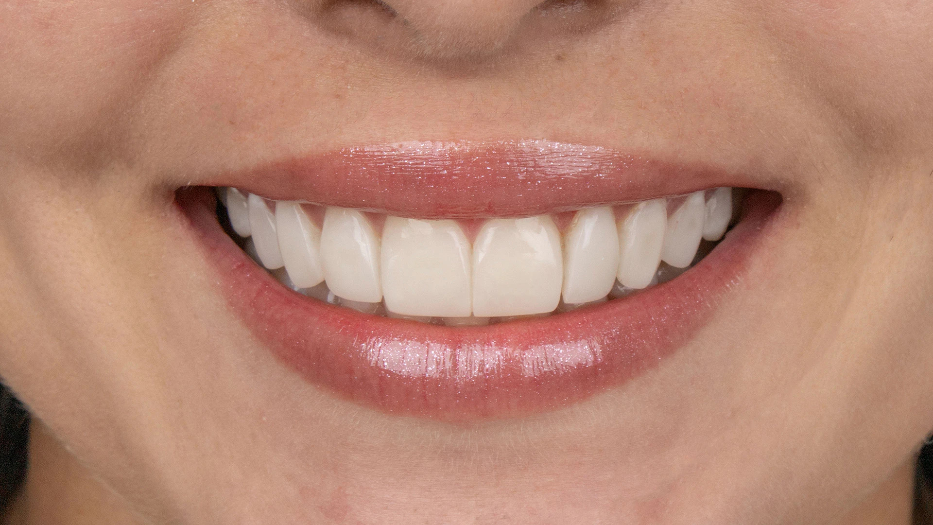 Natural smile with a front view of cosmetic dental work